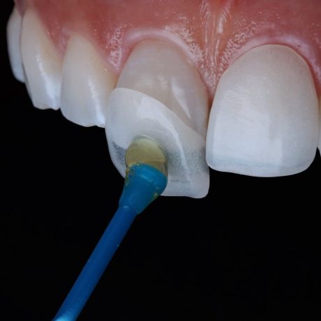 dental-veneers