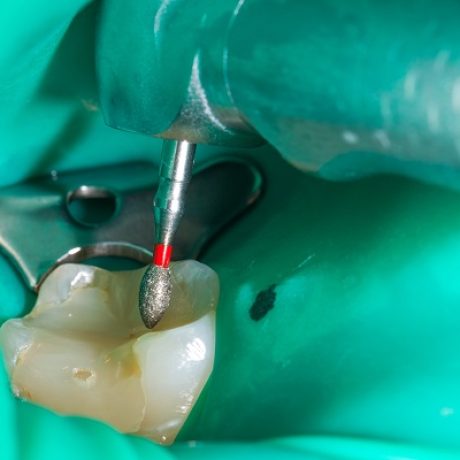 Close,Up,Picture,Of,An,Endodontic,Procedure,On,A,Human